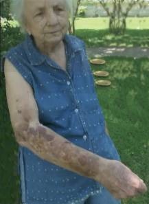 Betty Cash showing burns.